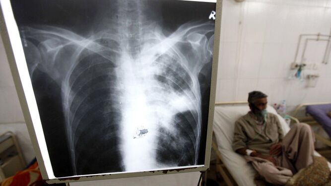 Un paciente enfermo de tuberculosis recibe tratamiento médico en un hospital de Peshawar, Pakistán.
